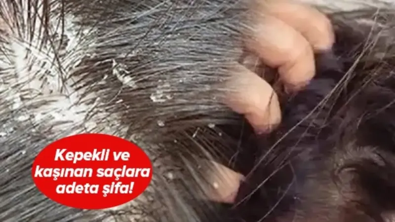 Kaşıntılı Saçlara Son! Kepeğe Veda, Uzayan Saçlar!